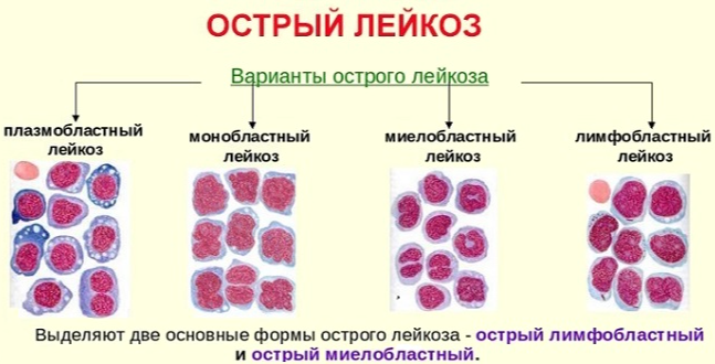 Лейкоз (лейкемия) - что это, симптомы и причины рака крови