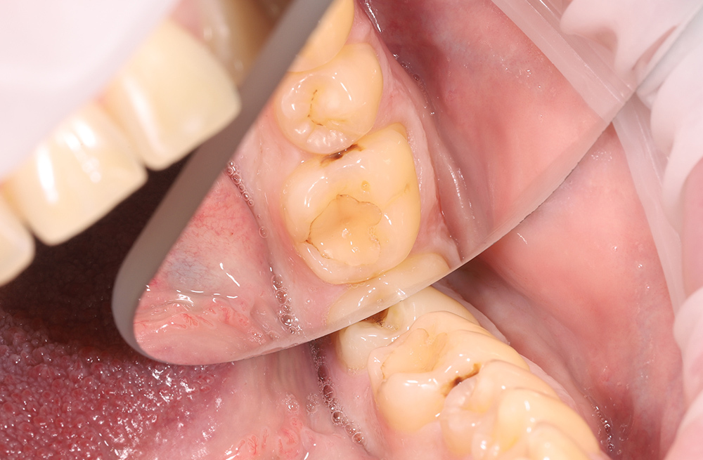 Препарирование и реставрация 36 зуба при вторичном кариесе с надежной изоляцией и полировкой пломбы