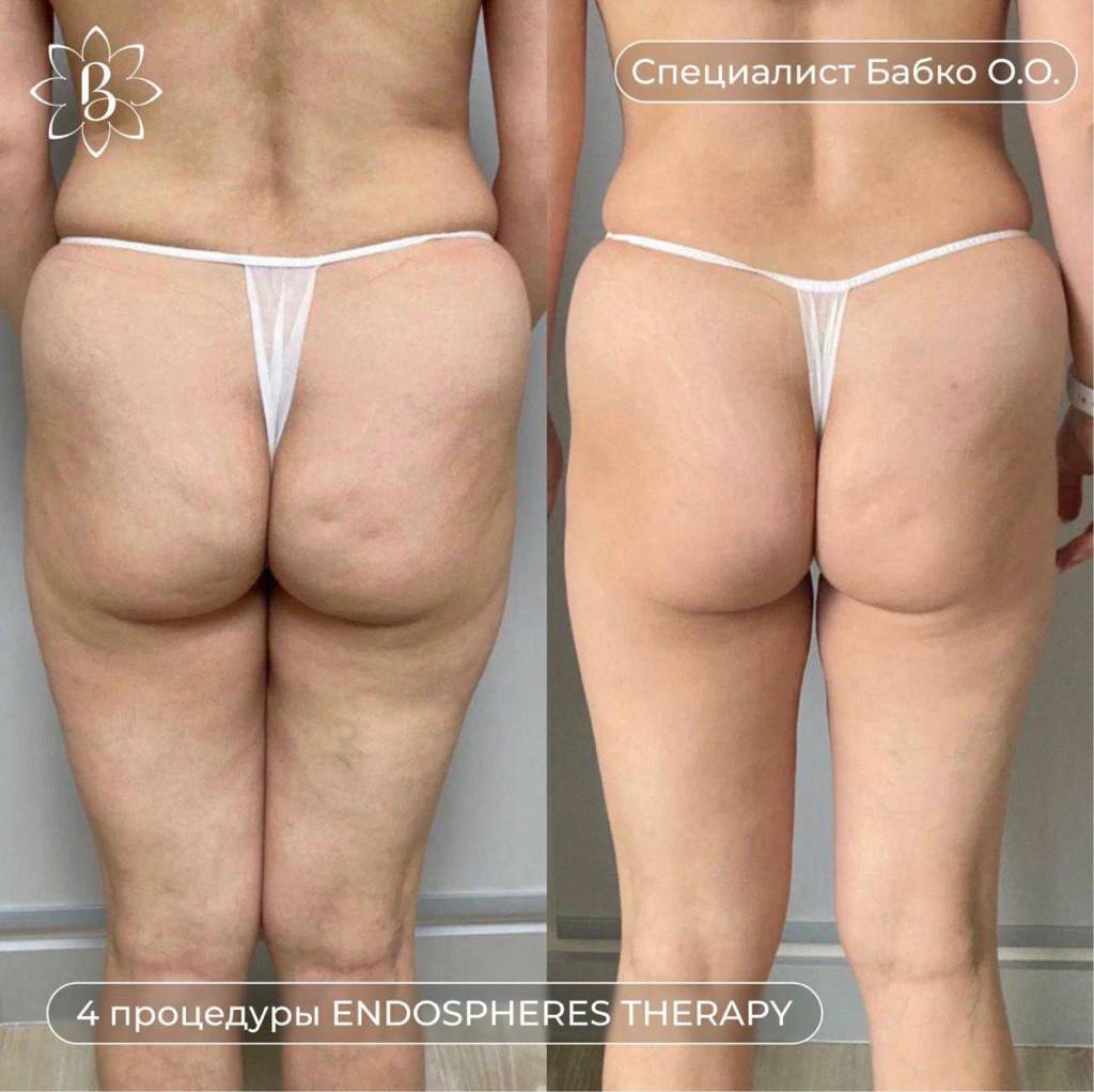 Hydrafacial - До и после