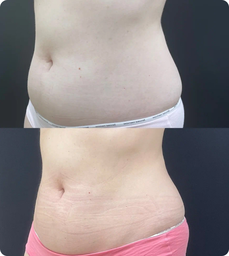 Липосакция СПб