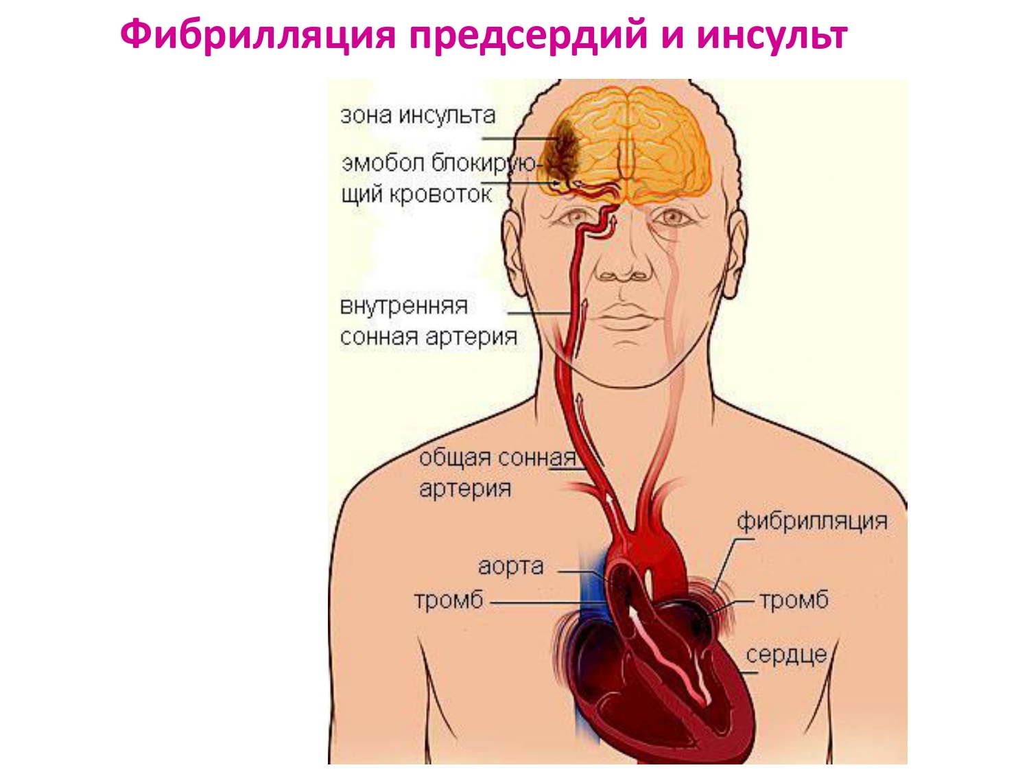 Инсульт левой артерии. Тромб в сердце оторвался. Тромбоз сердца симптомы.