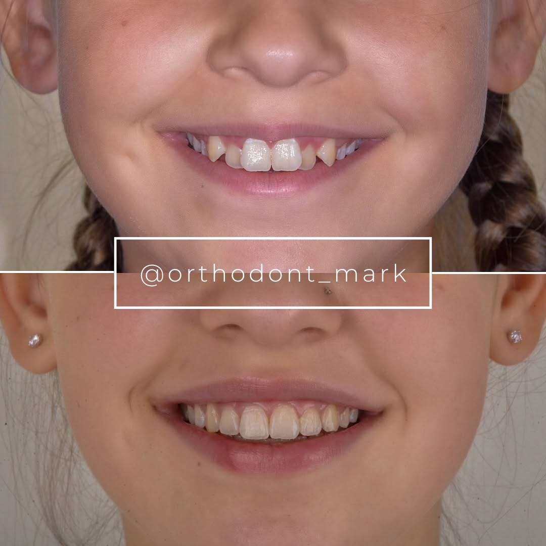 Narrow Maxilla and Severe Crowding Corrected with Arch Expansion