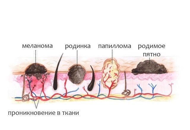 Папиллома это что простыми словами фото FT ЛАЗЕРНОЕ ЛЕЧЕНИЕ НОВООБРАЗОВАНИЙ