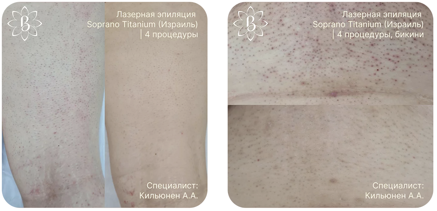 Лазерная фотоэпиляция. Чем отличается фотоэпиляция от лазерной. Лазерная или электроэпиляция разница. Фазы роста волос электроэпиляция. Разница лазера и фотоэпиляции.