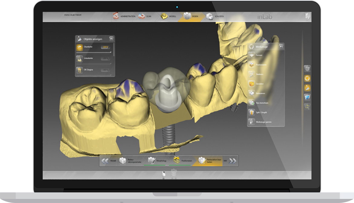 Керамические виниры на зубы в Киеве стоимость установки в Дабл.Дентал