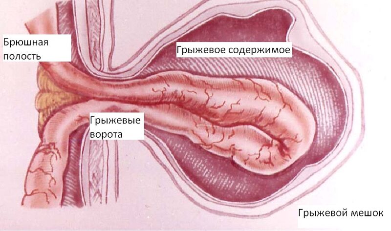 Операция Лихтенштейна при паховой грыже