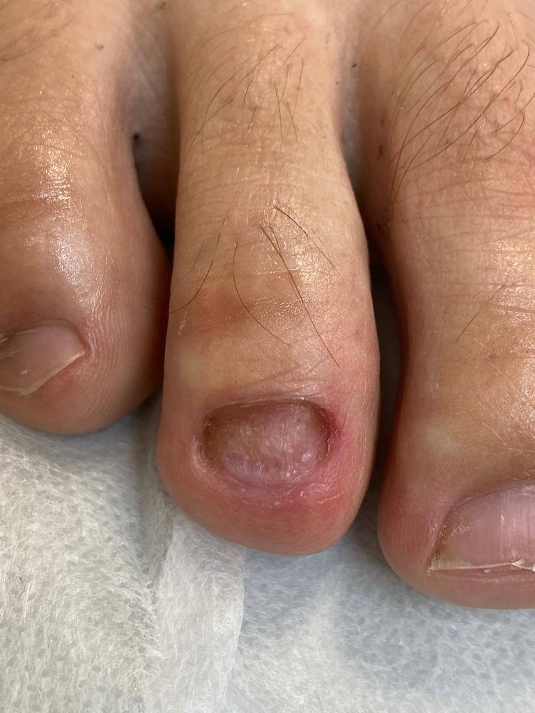 Обработка грибка ногтей