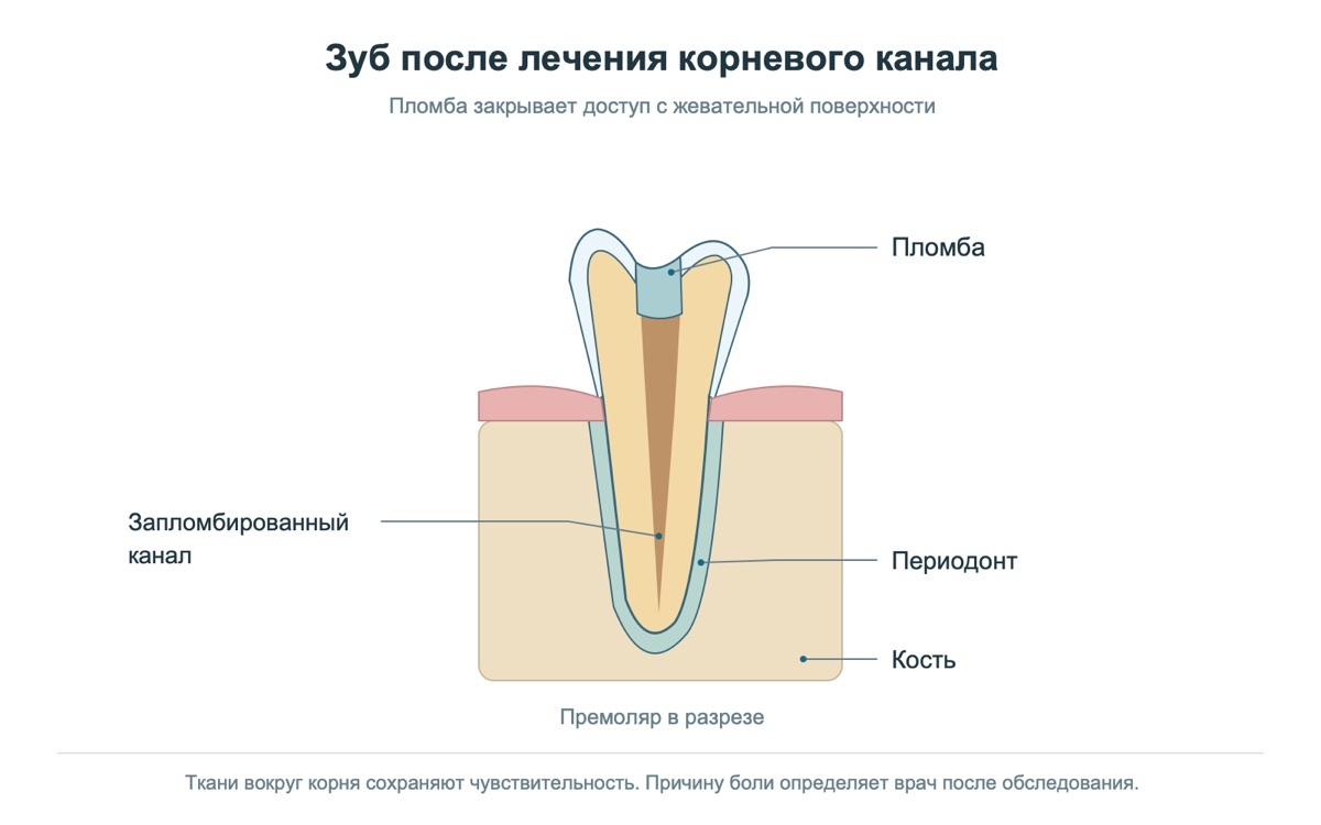 Схема зуба после эндодонтического лечения: корневые каналы и окружающие ткани