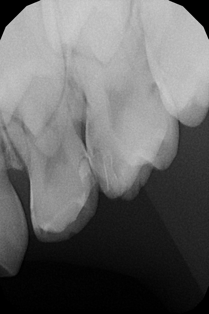 Детское лечение пульпита без боли с сохранением зуба