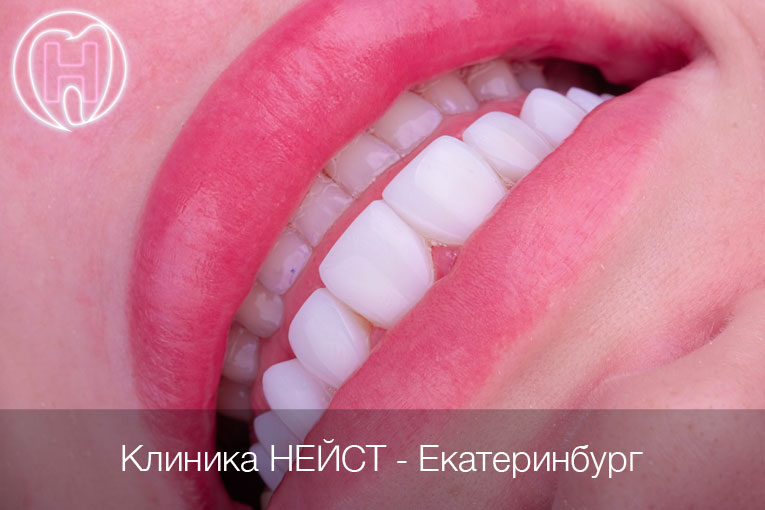 композитные виниры Стандарт в Екатеринбурге, цвет Блич 3