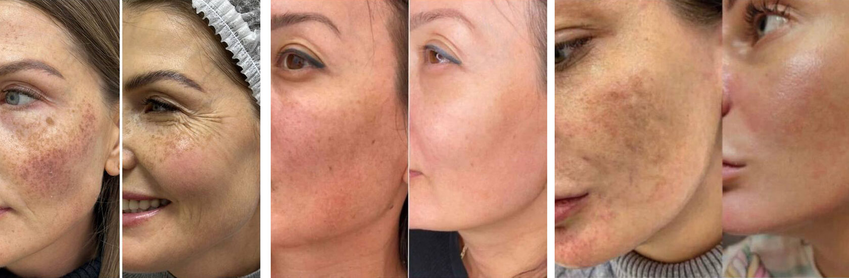 Результат ДО и ПОСЛЕ процедуры