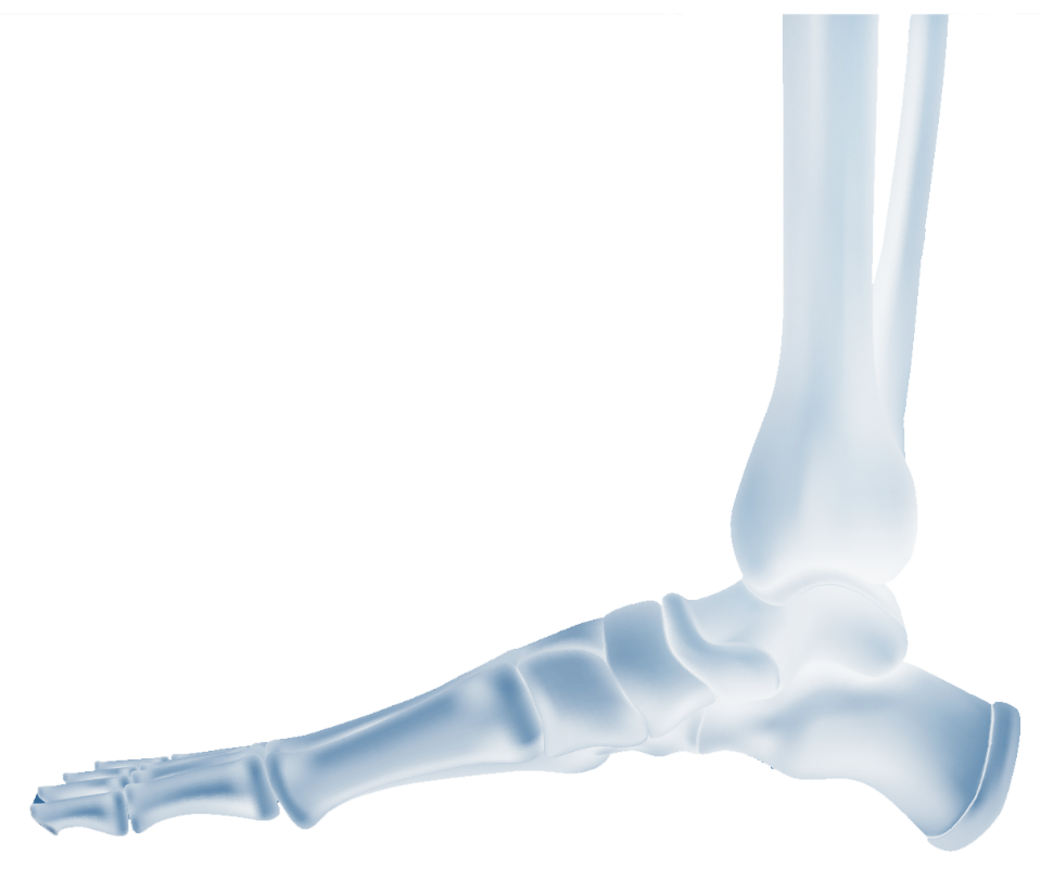Корреция 1 пальца стопы при вальгусной деформации
