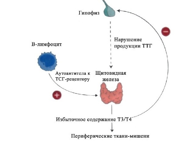 Диффузный токсический зоб