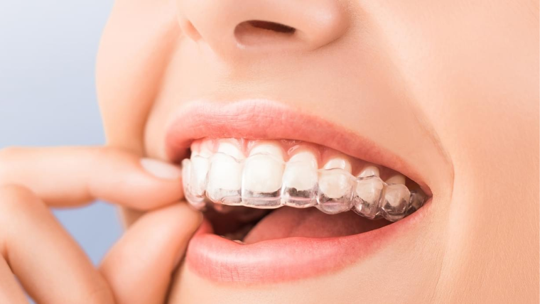 Элайнеры, исправление прикуса — цены в Дербенте. Стоматология DK