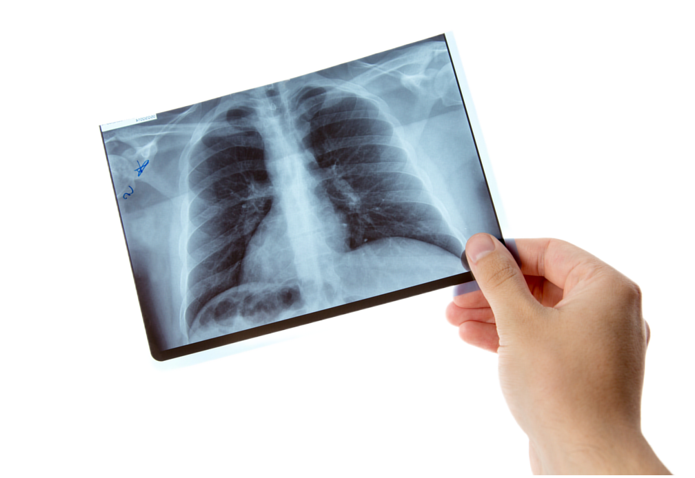 Флюорография в Нижнем Новгороде. Клиника "Блокада Боли"