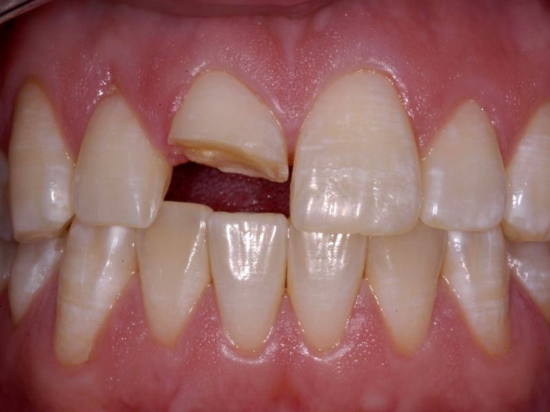 Сломался зуб или откололся кусок? Методы восстановления и лечения — ROOTT