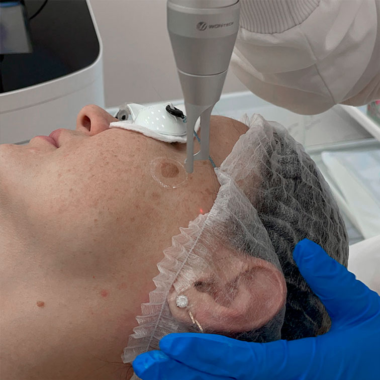 пигментные пятна