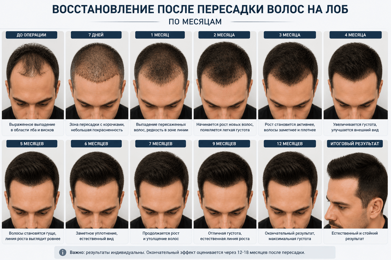 восстановление после пересадки волос на лоб