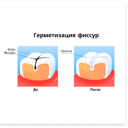 Фиссура зуба рисунок.