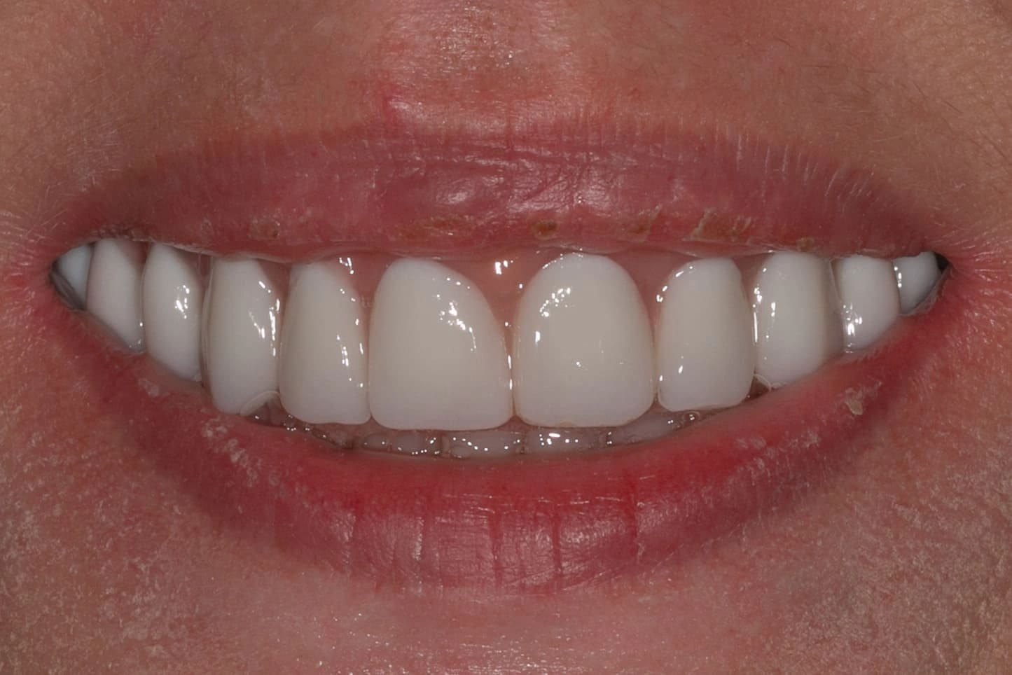 Циркониевая коронка Медентис Блог 7