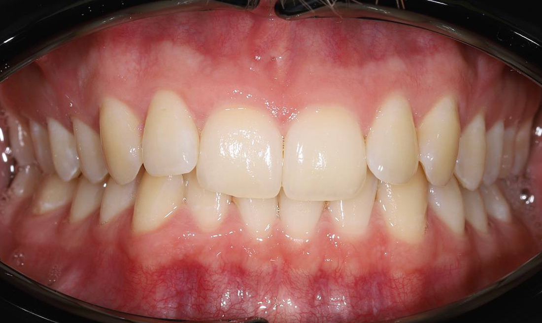 Ортодонтическое лечение металлическими брекетами Damon Q2