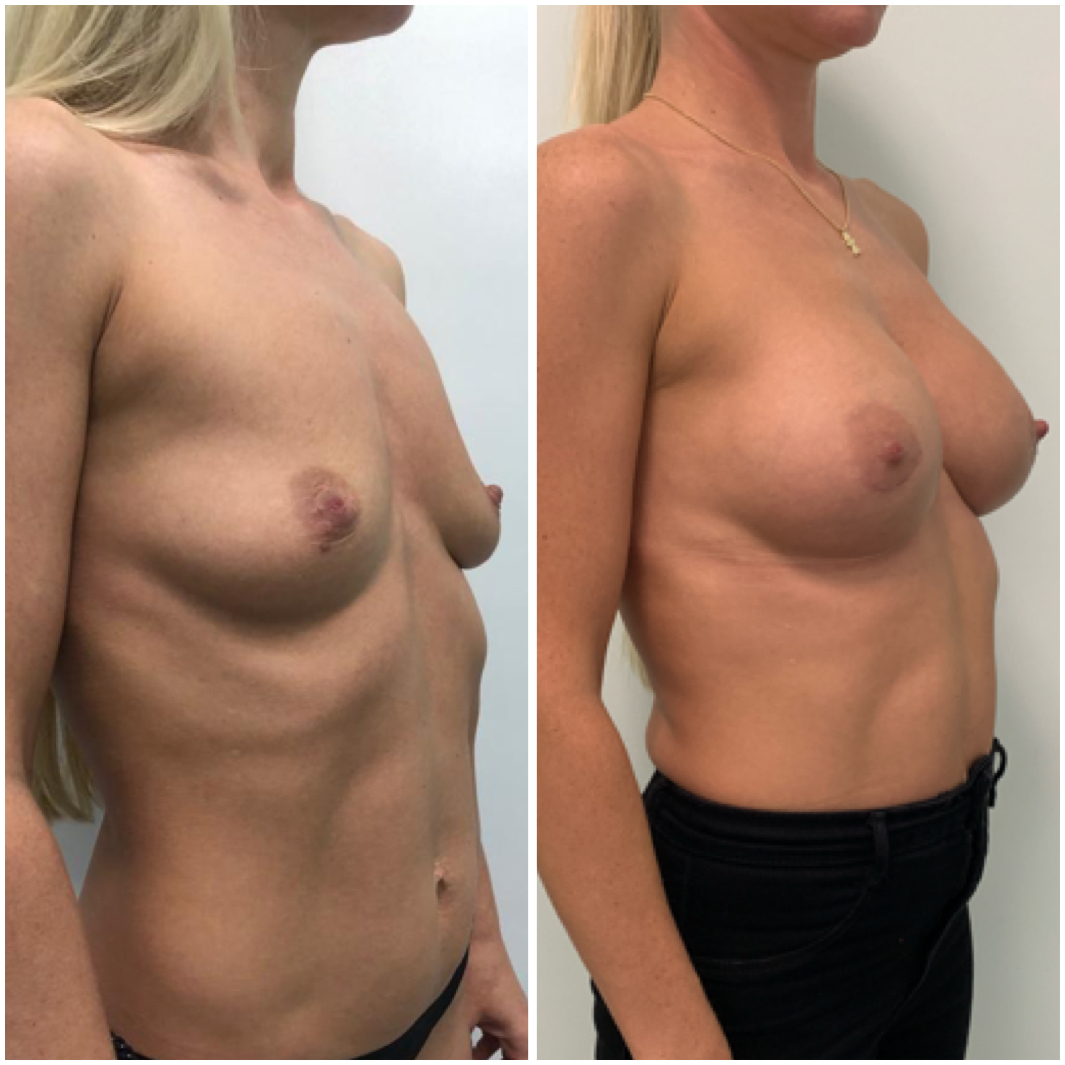 удаление импланта груди у женщин фото 60
