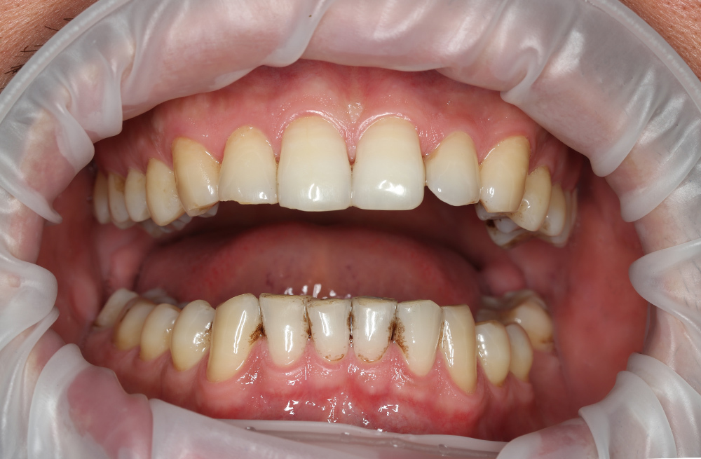 Глубокая чистка полости рта при выраженных отложениях курящего пациента