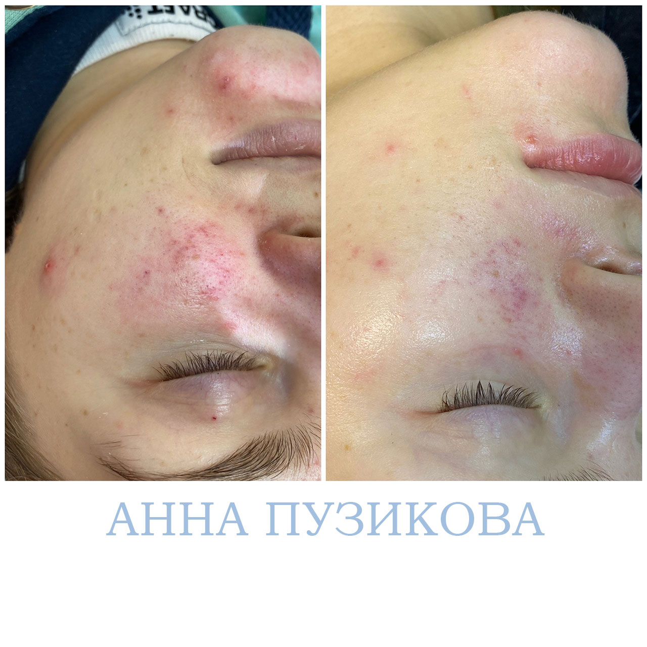 Результат лечения акне и воспалений кожи после курса процедур у косметолога Анны Пузиковой в клинике Прадус (СПб).