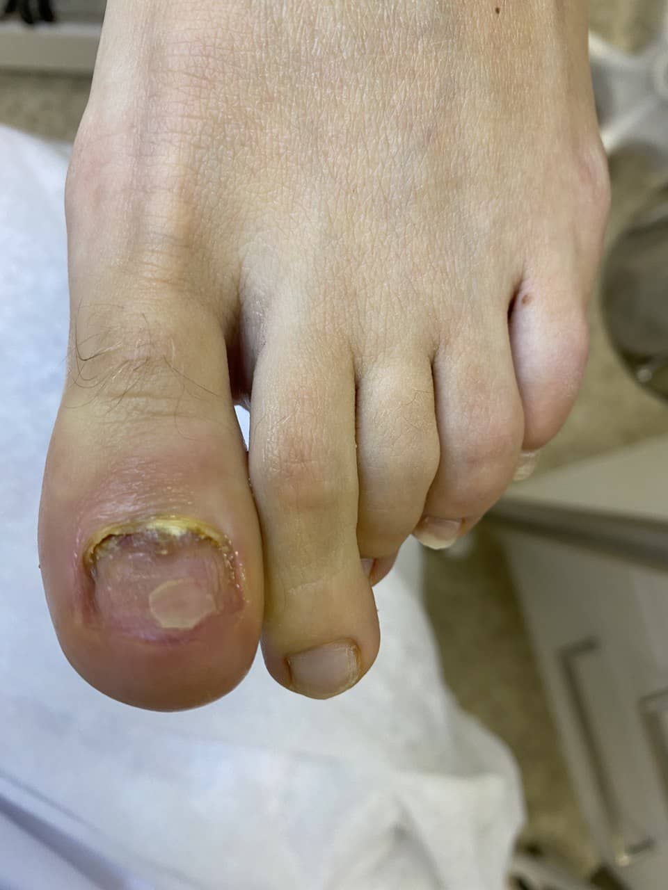 ногти после травмы на ноге