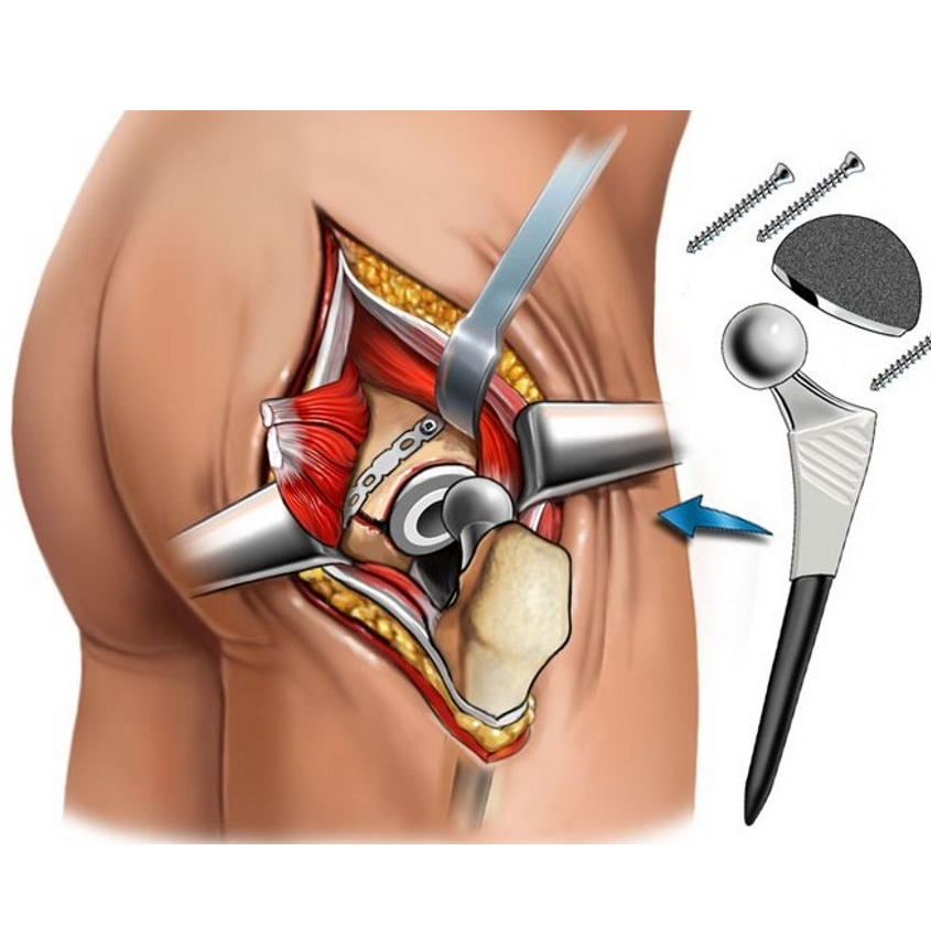 Эндопротезирование тазобедренного сустава фото операции