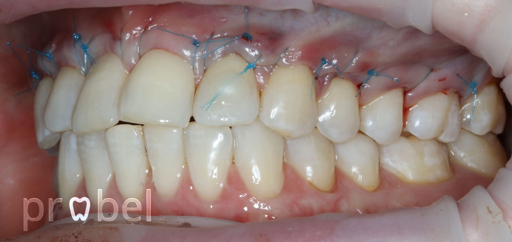 Операция пластики десны в Москве на Ленинградском в клинике Пробел