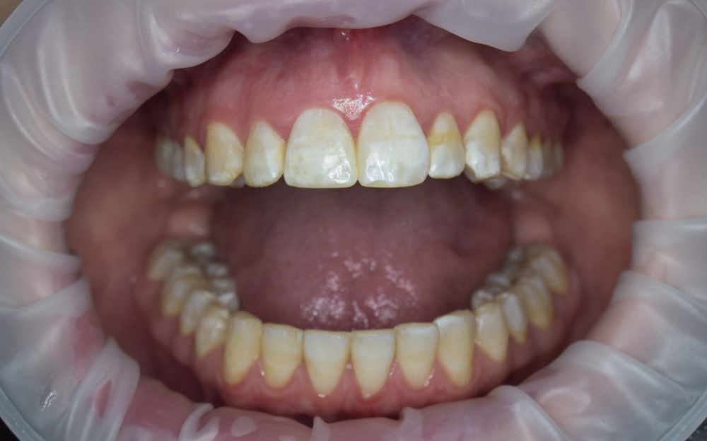 Эндемический флюороз зубов