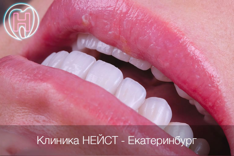 красивые керамические виниры Премиум цвет Блич 2 (Bleach 2)