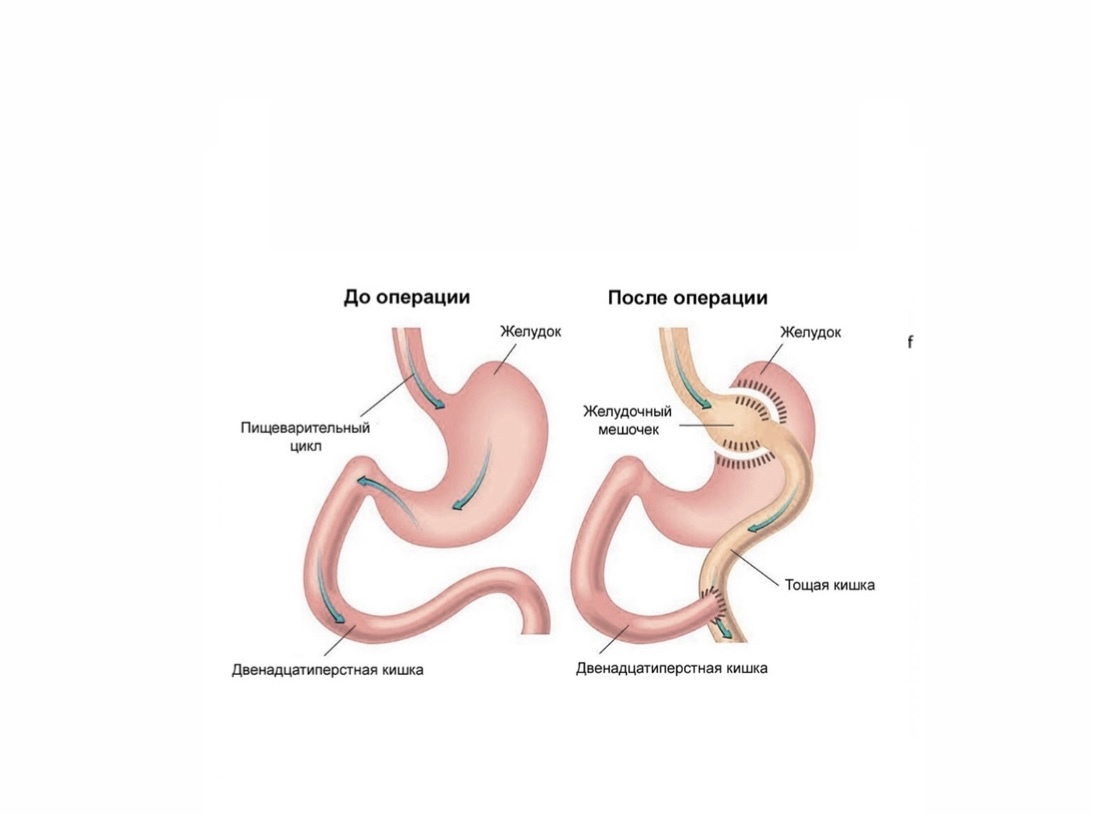 Бариатрическая Операция Цена К31