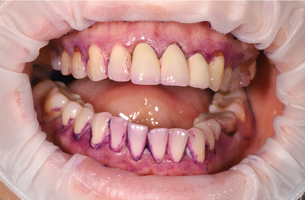 Профессиональная гигиена зубов после двухлетнего перерыва