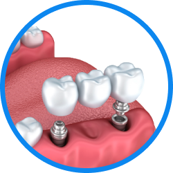 Установка имплантов в Дербенте. Имплантация при отсутствии одного зуба.