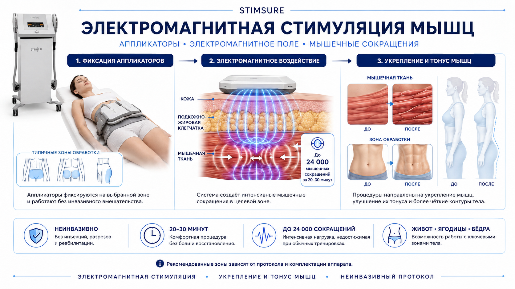 StimSure — инфографика механизма электромагнитной стимуляции мышц