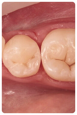 Лечение кариеса в стоматологии Дент-Арт