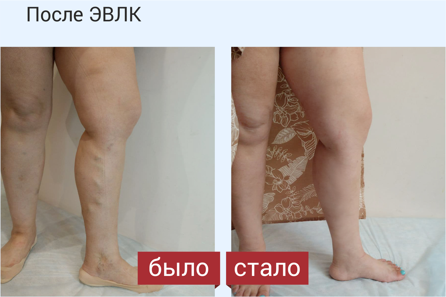 ЭВЛК — лазерное лечение варикоза в Коломне