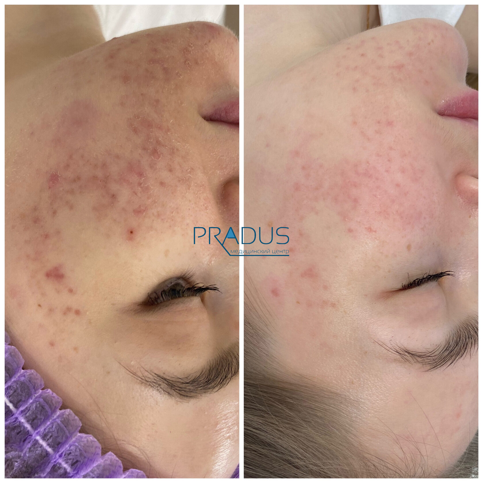 Лечение акне у женщины в клинике PradusCOSMO, СПб. До и после процедуры