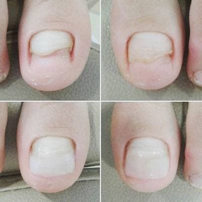 Протезирование ногтевой пластины в Курске