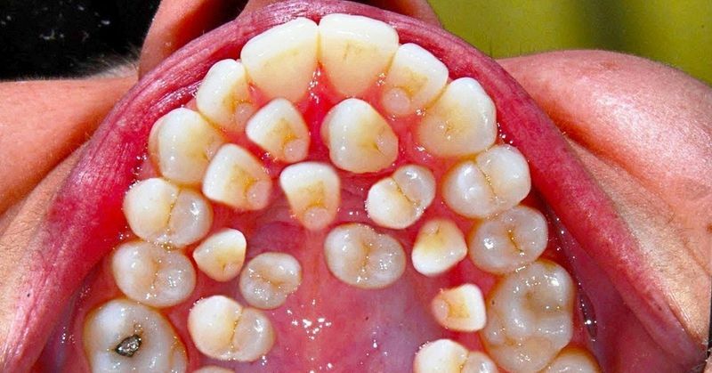 Сверхкомплектный зуб - что это такое и надо ли удалять