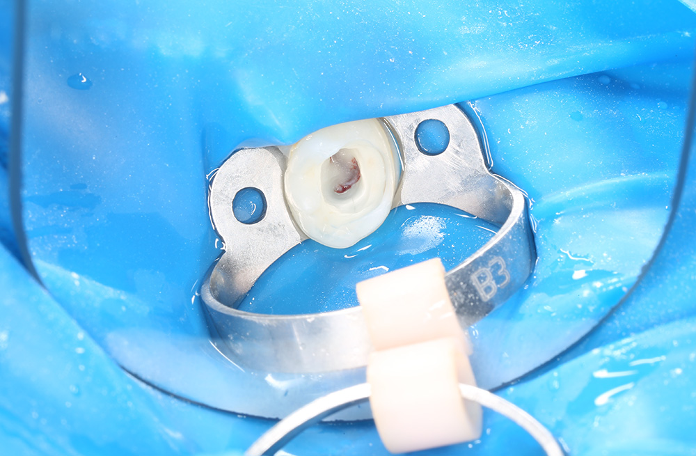 Сохранение зуба при обратимом пульпите