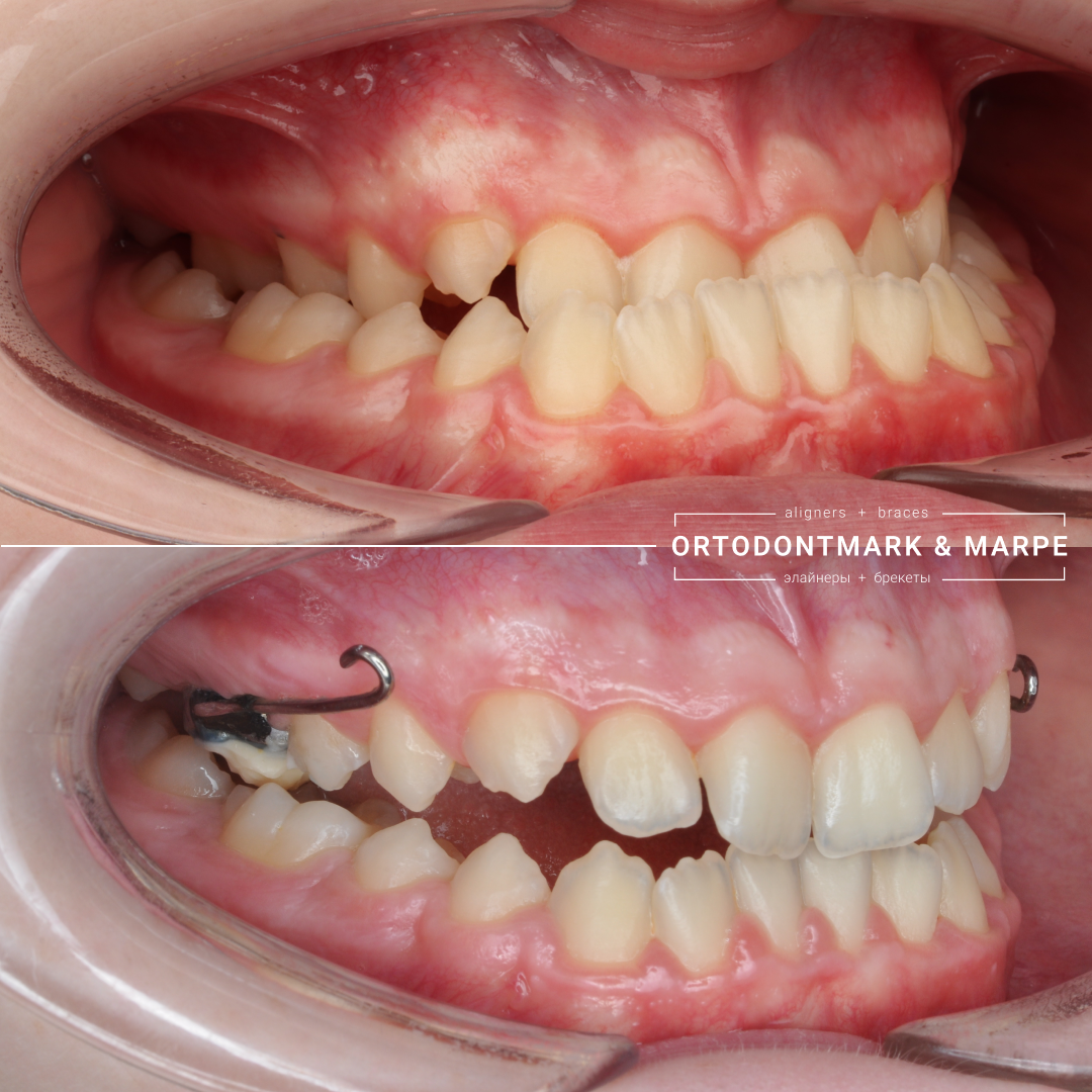 MARPE case result 15