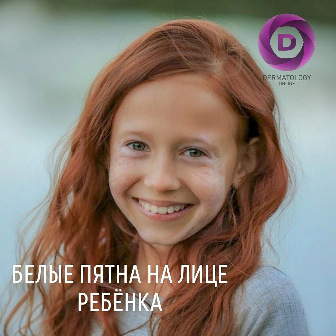 Витилиго? Белые пятна на лице у ребёнка, лечение, консультация, причины