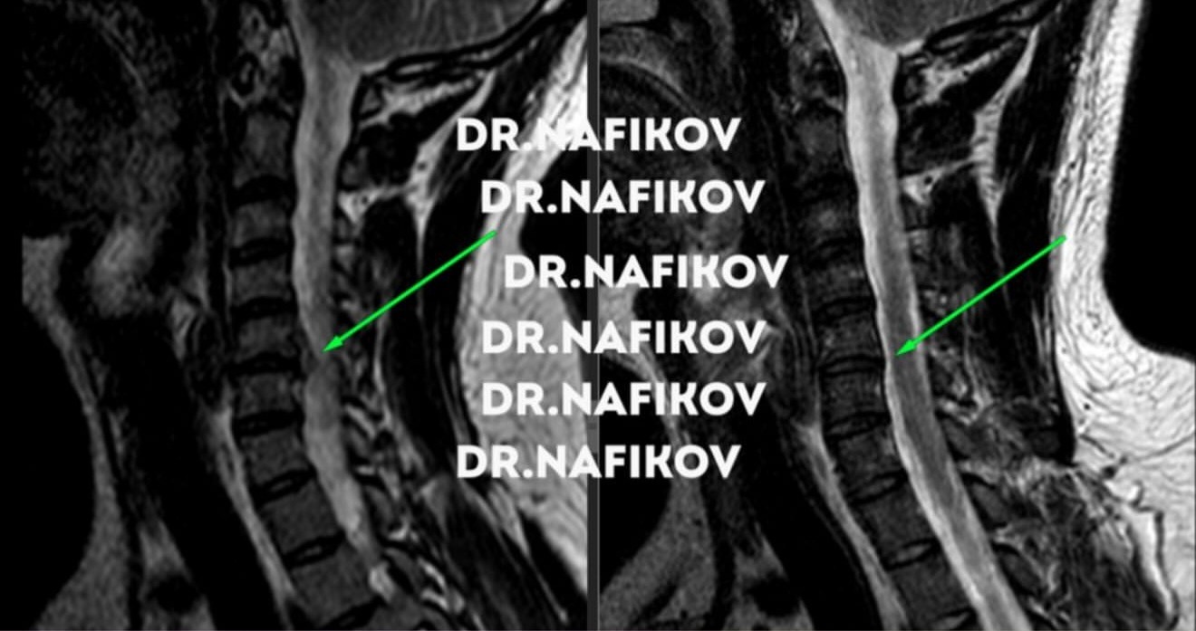 МРТ до и после лечения, Пациент Б., 33 года