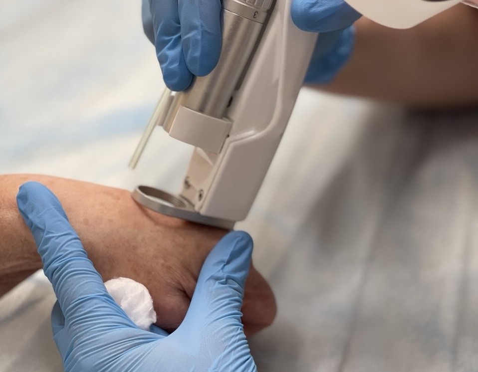 Лазерное удаление пигментации на Quanta System Duetto (Александрит)