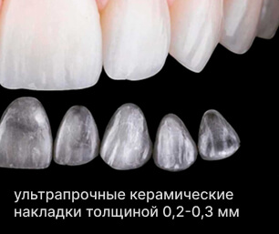 Ультратонкие керамические накладки люминиры