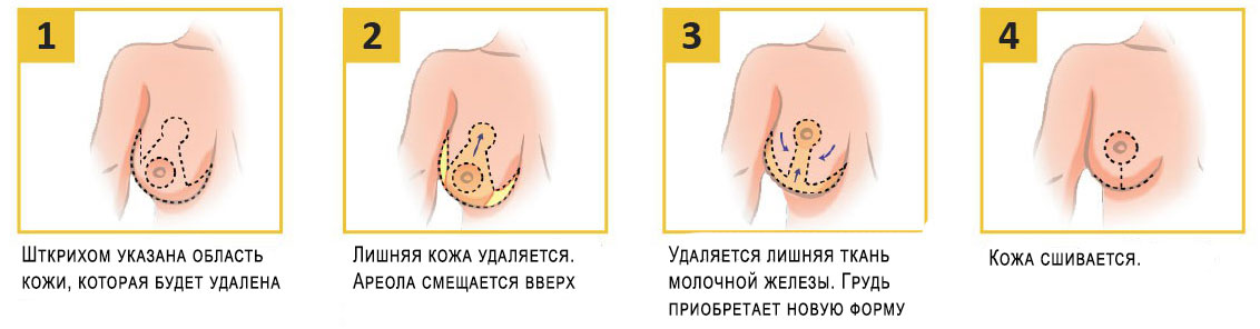 Коррекция сосков и ареолы в Санкт-Петербурге - цена операции, фото до и после
