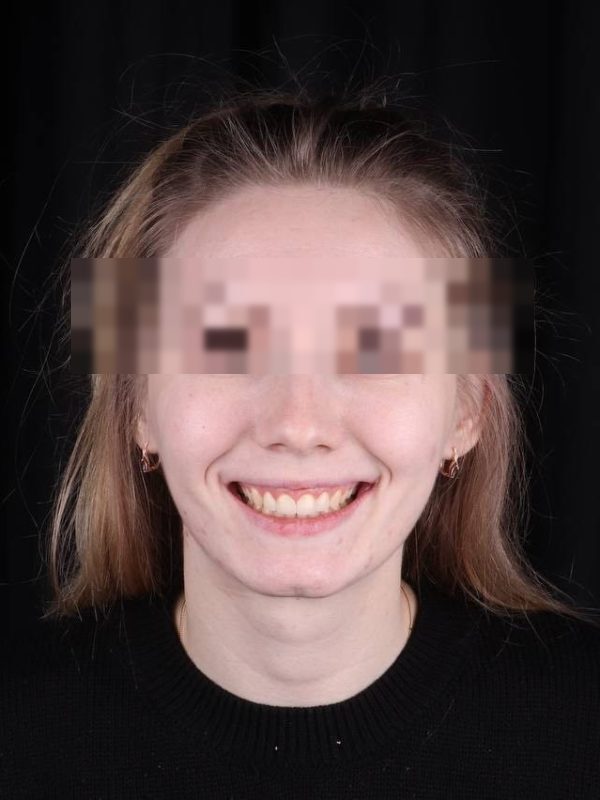 Исправление прикуса — фото после лечения, Elite Denta